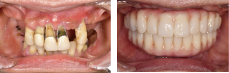 インプラントの症例01