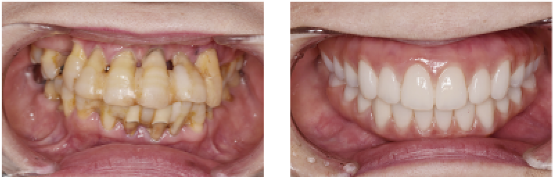 インプラントの症例02