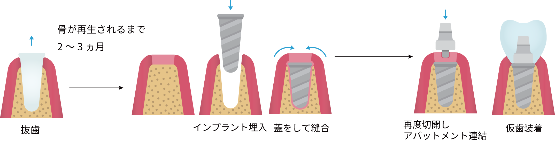 一般的なインプラントの流れ